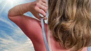 Sunburn Remedies