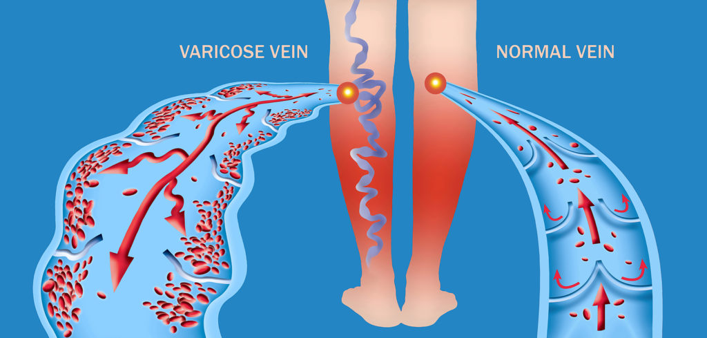 Varicose Veins vs. Spider Veins: What You Need To Know