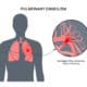 3 Symptoms of Pulmonary Embolism