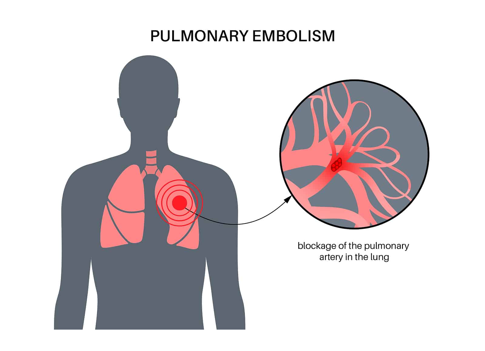 3 Symptoms of Pulmonary Embolism